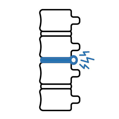 ACUTE LUMBAR DISC INJURIES